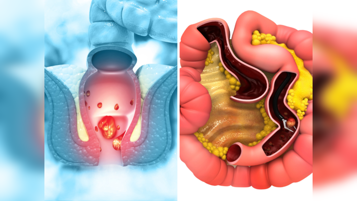 शौचाच्या जागी गाठ व ब्लीडिंग होते? मुळव्याध आहे की कोलोरेक्टल कॅन्सरची सुरूवात, असा ओळखा दोन्ही लक्षणांतला फरक