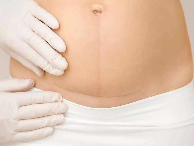 c-section-