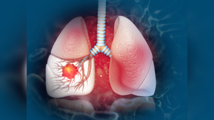 Lung Cancer Remedies : फुफ्फुसे आतून पोखरून निकामी करतात या 3 गोष्टी, कॅन्सरपासून बचावासाठी लगेच करा हे 5 उपाय