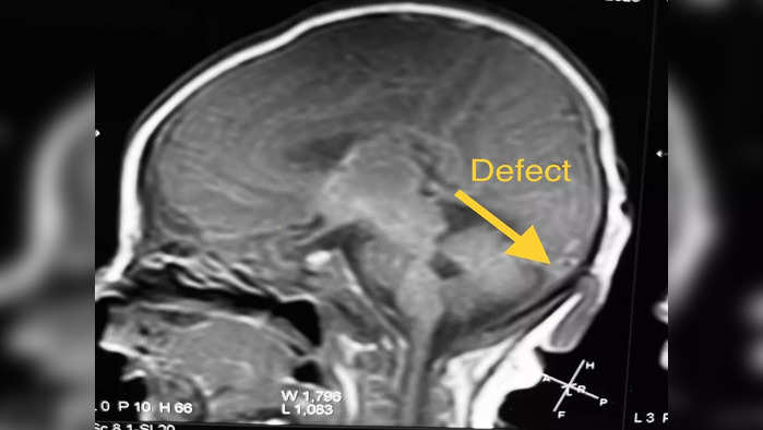 ५ दिवसाच्या बाळाच्या डोक्यावरील गाठीची यशस्वी शस्त्रक्रिया