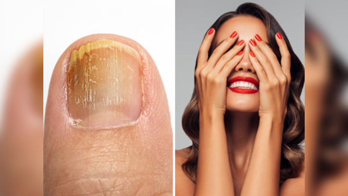 Nail Growth : नखं पिवळी दिसतात? कुठं फंगल इन्फेक्शन तर नाही? नखांची घ्या अशी काळजी