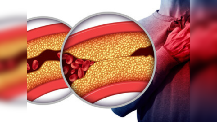 छुप्या हृदयरोगामुळे येऊ शकतो Heart Attack, म्हणजे नक्की काय? तरूणांचा जातोय जीव