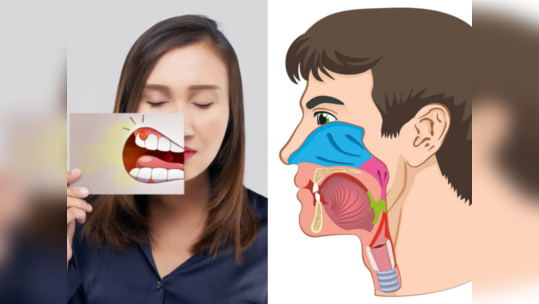 तोंडाच्या कॅन्सरची चिन्हे आणि लक्षणे आधीच ओळखा, ठरू शकतो घातक