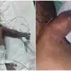 ప్రభుత్వ ఆసుపత్రి నిర్లక్ష్యం.. 18 రోజుల పసికందు ఎడమ చేయి తొలగింపు..!
