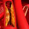 Calcification in arteries: శరీరంలో కాల్షియం స్థాయిలు పెరిగితే.. హై ...