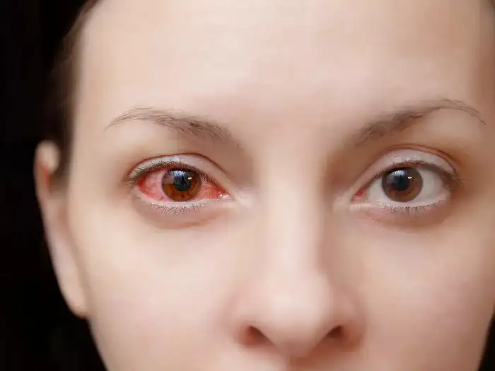 Eye Twitching Causes,Eye Twitching : வலது கண், இடது கண் எது ...