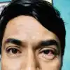 Madras Eye Or Pink Eye Infection Symptoms : வேகமாக பரவி வரும் மெட்ராஸ் ...