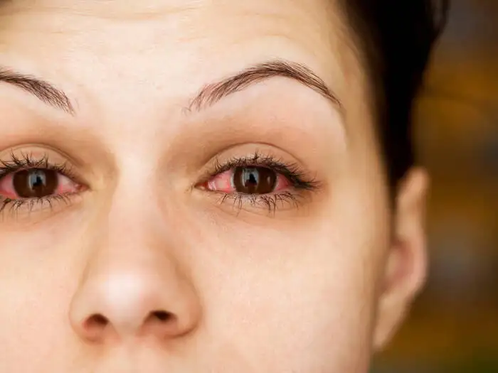 Madras Eye Or Pink Eye Infection Symptoms : வேகமாக பரவி வரும் மெட்ராஸ் ...