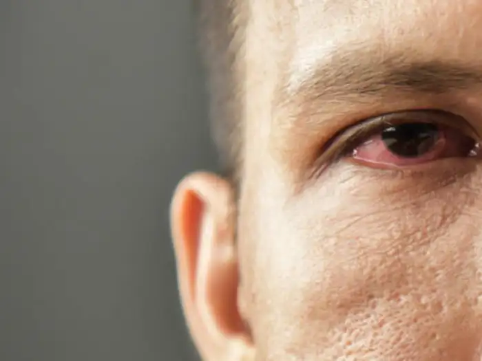 Madras Eye Or Pink Eye Infection Symptoms : வேகமாக பரவி வரும் மெட்ராஸ் ...