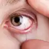 Best 6 Home Remedies For Eye Dryness : கண் ரொம்ப வறண்டு எரிச்சலா ...