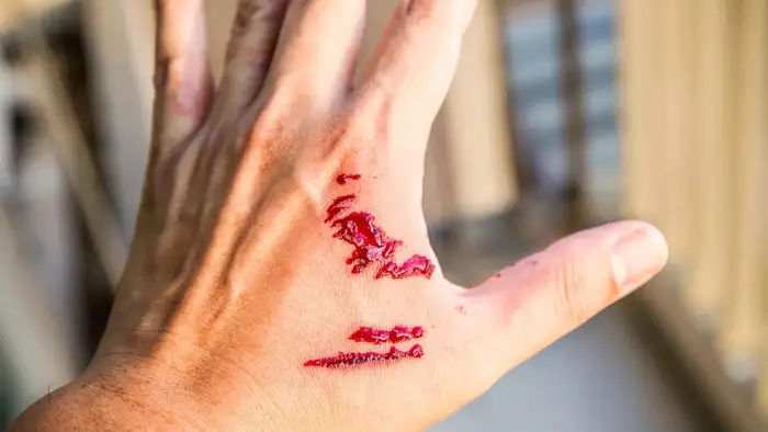 <strong>நாய் கடித்த உடன்  உடனடி மருத்துவ சிகிச்சை எப்போது தேவை?</strong>