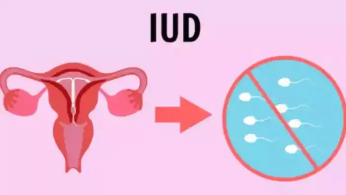 IUD Advantages and Disadvantages: காப்பர் டி யூஸ் பண்ணா எடை ...