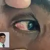 Madras Eye Symptoms,“மெட்ராஸ் ஐ” வந்தா என்ன பண்ணனும்? அறிகுறிகள் ...