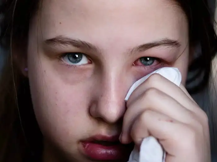Madras Eye Symptoms,“மெட்ராஸ் ஐ” வந்தா என்ன பண்ணனும்? அறிகுறிகள் ...