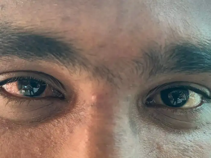Madras Eye Symptoms,“மெட்ராஸ் ஐ” வந்தா என்ன பண்ணனும்? அறிகுறிகள் ...