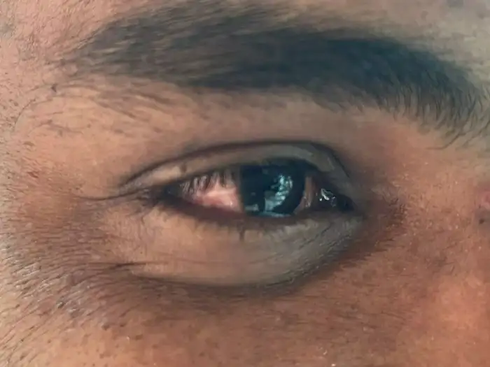 Madras Eye Symptoms,“மெட்ராஸ் ஐ” வந்தா என்ன பண்ணனும்? அறிகுறிகள் ...