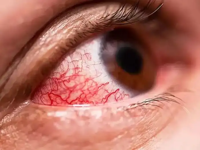 Madras Eye Symptoms,“மெட்ராஸ் ஐ” வந்தா என்ன பண்ணனும்? அறிகுறிகள் ...