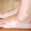 Swelling On Body,ದೇಹದಲ್ಲಿ ಯಾವುದೇ ಗಾಯವಿಲ್ಲದಿದ್ದರೂ ಊತವನ್ನು ಉಂಟುಮಾಡುವ ...