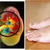Are Leg Cramps A Symptom Of Kidney Disease,ಕಿಡ್ನಿ ಡ್ಯಾಮೇಜ್ ಆದರೆ ...