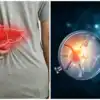 ಲಿವರ್‍ನಲ್ಲಿ ಇನ್ಫೆಕ್ಷನ್ ಕಾಣಿಸಿಕೊಳ್ಳುವುದು ಯಾಕೆ? ಇದರ ರೋಗಲಕ್ಷಣಗಳು ...