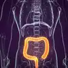 What Is Colon Infection,ಕರುಳಿನ ಸೋಂಕು ಎಂದರೇನು? ಇದರ ಲಕ್ಷಣಗಳು ಹಾಗೂ ...