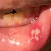 Causes For Mouth Ulcer,ಬಾಯಿ ಹುಣ್ಣಾಗಿ ಏನೂ ತಿನ್ನೋಕೆ ಆಗ್ತಿಲ್ವಾ..? ಇಲ್ಲಿದೆ ...