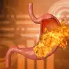 Acidity Symptoms,ಎಚ್ಚರ! ಆಸಿಡಿಟಿ ಈ ಭಯಾನಕ ರೋಗದ ಲಕ್ಷಣಗಳಾಗಿರಬಹುದು ...