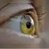 Eye Health,ಕಣ್ಣಿನ ರೆಪ್ಪೆ ಪದೇ ಪದೇ ಬಡಿಯುತಿದ್ಯಾ? ಅಪಶಕುನ ಅಲ್ಲ ಈ ಸಮಸ್ಯೆ ...