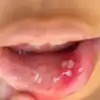 Mouth Ulcers (ಬಾಯಿ ಹುಣ್ಣುಗಳು) Home Remedies - ಬೇಸಿಗೆಯಲ್ಲಿ ಕಾಡುವ ...